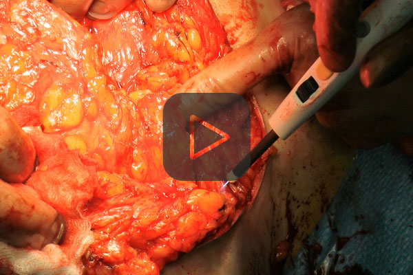 APCapplicator in mamma surgery