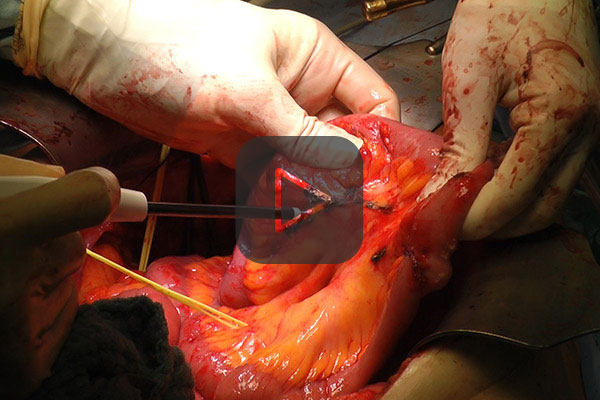 Peritonealkarzinose mit APCapplicator